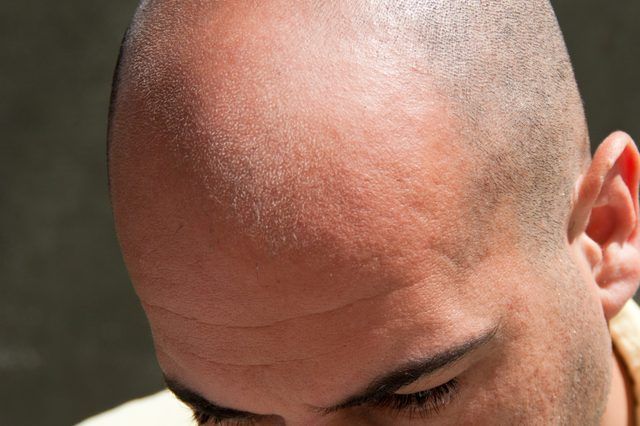 Comment faire pour éliminer le service d'une tête chauve