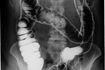 X-ray de l'intestin et du bassin