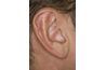 Vérifiez l'oreille pour vous assurer que la tique's head doesn't remain behind during removal.